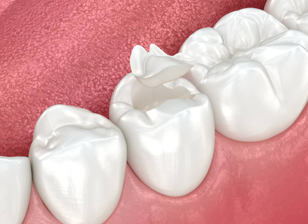 Best Dental Inlays and Onlays  in USA